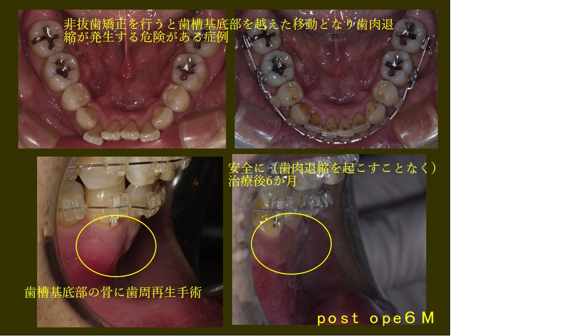 危険！？】非抜歯矯正のリスクについて症例で説明 - 東京日本橋AQUA歯科・矯正歯科包括CLINIC