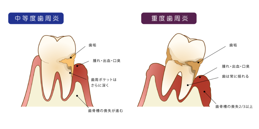麻酔もメスも使わない低侵襲な歯周病治療 トリプルペリオとは？ - 東京 