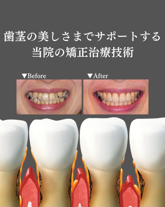 .
【歯肉退縮している方への治療】
最近歯茎が下がってきた・矯正治療をしたら歯茎が下がってきた、とお悩みの方も多いのではないでしょうか。
.
歯茎が下がる原因はさまざまですが、日本人は欧米人と比べて歯茎の退縮リスクが高く歯茎が下がりやすいといわれています。
.
当院では幅広い専門分野を駆使した包括的成人矯正治療をコンセプトとして、多様なアプローチで治療を行なっていきます。
お悩みの患者様はお気軽にご相談ください。

#矯正 #矯正治療 #歯並び #歯並び矯正 #出っ歯 #口ゴボ #歯列矯正 #歯並び #歯列矯正 #歯科矯正 #矯正 #矯正歯科 #歯並び矯正 #ワイヤー矯正 #dentist #orthodontics #歯肉退縮 #歯肉 #歯茎が下がる