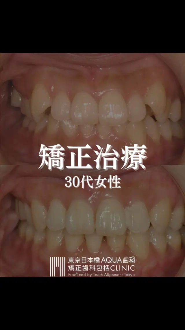 .
【矯正治療】
30代女性の矯正治療症例です。
.
歯並びにお悩みの患者様に対し、歯を正しい位置に戻す治療を行いました。
.
#矯正 #矯正治療 #歯並び #歯並び矯正 #出っ歯 #口ゴボ #歯列矯正 #歯並び #歯列矯正 #歯科矯正 #矯正 #矯正歯科 #歯並び矯正 #ワイヤー矯正 #dentist #orthodontics