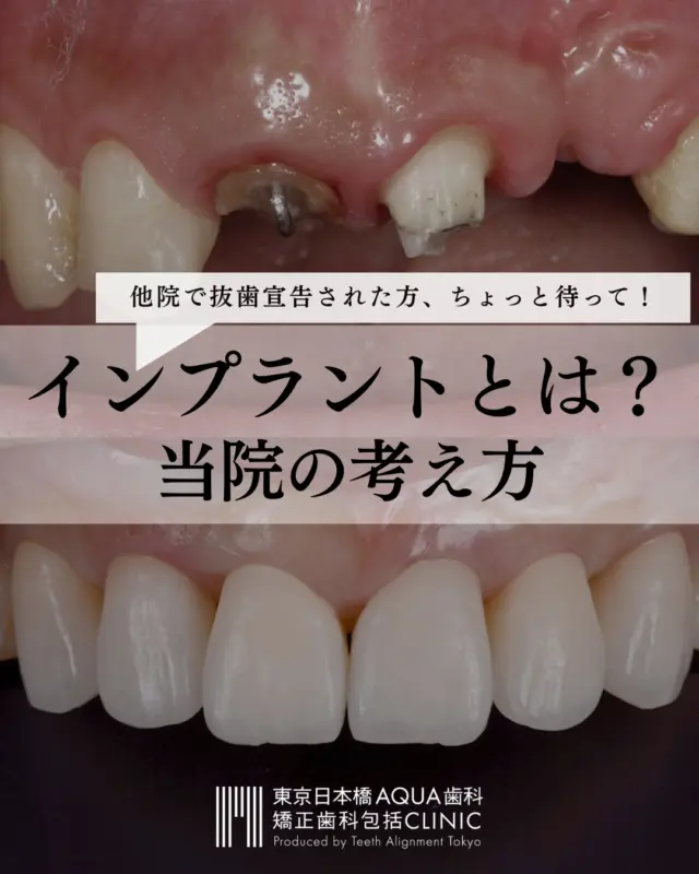 .
【インプラント治療について】
インプラント治療は、近年の歯科医学の中でも最も大きな発展を遂げた治療です。
.
当院では、天然歯を残せる可能性が少しでもあるならば「できる限りインプラントは避けた方がいい」という考え方で診査・診断に当たっています。私たちの信念は、天然歯を1本でも多く残すことです。
.
あらゆる可能性を考慮しても天然歯を残すことができない場合、近代の歯科医療で治療の第一選択肢となるのはインプラントです。
.
当院では安易なインプラント治療は行わず、抜歯に至った原因を徹底的に診断し、インプラント治療だけでなく包括的な視点からインプラント治療にあたっています。
.
お悩みの患者様、他院で抜歯宣告をされた患者様はお気軽にご相談ください。
.
#インプラント #インプラント治療 #矯正 #矯正治療 #歯並び #歯並び矯正 #出っ歯 #口ゴボ #歯列矯正 #歯並び #歯列矯正 #歯科矯正 #矯正 #矯正歯科 #歯並び矯正 #ワイヤー矯正 #dentist #orthodontics #歯肉退縮 #歯肉 #歯茎が下がる
