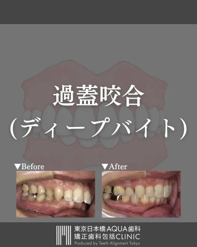 .
【過蓋咬合 (ディープバイト)の治療】
かみ合わせが深く、下の歯がほとんど見えない歯並びをを過蓋咬合・かがいこうごう（ディープバイト）と呼びます。
.
当院で治療された患者様の症例をご紹介いたします。
.
お悩みの患者様はお気軽にご相談ください。
.
#インプラント #インプラント治療 #矯正 #矯正治療 #歯並び #歯並び矯正 #出っ歯 #口ゴボ #歯列矯正 #歯並び #歯列矯正 #歯科矯正 #矯正 #矯正歯科 #歯並び矯正 #ワイヤー矯正 #dentist #orthodontics #歯肉退縮 #歯肉 #歯茎が下がる #ディープバイト #過蓋咬合