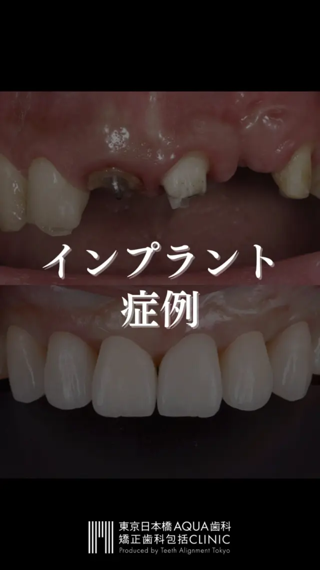 .
【インプラント治療の症例】
当院で行ったインプラント治療の症例のご紹介です。
.
当院では安易なインプラント治療は行わず、抜歯に至った原因を徹底的に診断し、インプラント治療だけでなく包括的な視点からインプラント治療にあたっています。
.
お悩みの患者様、他院で抜歯宣告をされた患者様はお気軽にご相談ください。
.
#インプラント #インプラント治療 #矯正 #矯正治療 #歯並び #歯並び矯正 #出っ歯 #口ゴボ #歯列矯正 #歯並び #歯列矯正 #歯科矯正 #矯正 #矯正歯科 #歯並び矯正 #ワイヤー矯正 #dentist #orthodontics #歯肉退縮 #歯肉 #歯茎が下がる