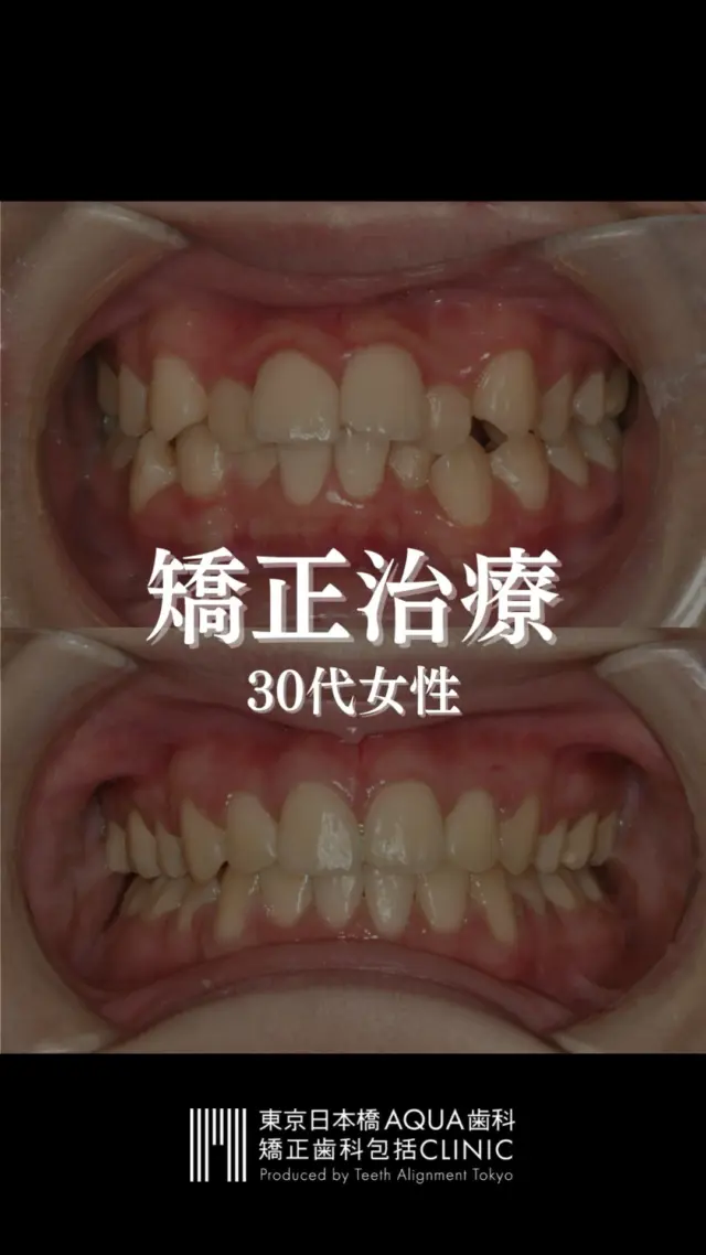 .
【矯正治療】
30代女性の矯正治療経過です。
.
治療期間は2〜3年でここまで綺麗になります。
.
お悩みの患者様はお気軽にご相談ください。
.
#矯正 #矯正治療 #歯並び #歯並び矯正 #出っ歯 #口ゴボ #歯列矯正 #歯並び #歯列矯正 #歯科矯正 #矯正 #矯正歯科 #歯並び矯正 #ワイヤー矯正 #dentist #orthodontics