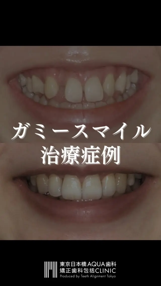 .
【ガミースマイルの治療症例】
ガミースマイルとは、笑った時に歯茎が大きく見えてしまう状態のことです。
一般的に、上唇をイーの字に結んだ時に歯茎が全く見えない、または少しだけ見える状態が理想とされていますが、ガミースマイルの場合、上顎の歯茎が3mm以上見えてしまう状態を指します。
.
ガミースマイルの診査・診断と治療計画には、審美歯科と矯正歯科の専門的な対応が不可欠です。
当院では、矯正歯科、審美歯科、そして歯周外科に対して専門的な対応を行っておりますので、安心してご相談ください。
.
#ガミースマイル #矯正 #矯正治療 #歯並び #歯並び矯正 #出っ歯 #口ゴボ #歯列矯正 #歯並び #歯列矯正 #歯科矯正 #矯正 #矯正歯科 #歯並び矯正 #ワイヤー矯正 #dentist #orthodontics