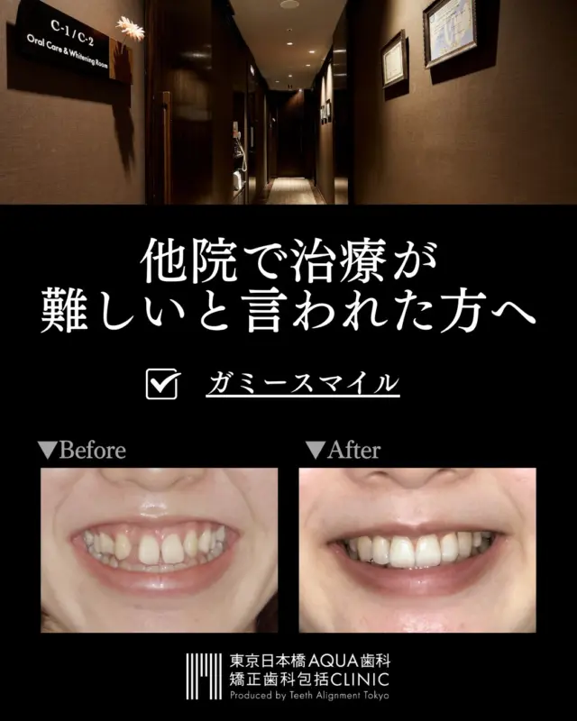 .
【他院では治療が難しいと言われた方へ】ガミースマイル
.
笑った時に歯茎が大きく見えてしまう状態をガミースマイルと呼びます。
.
当院では、矯正歯科、審美歯科、そして歯周外科に対して専門的な対応を行っておりますので、
ガミースマイルにお悩みの方は安心してご相談ください。
.
#ガミースマイル  #矯正 #矯正治療 #歯並び #歯並び矯正 #出っ歯 #口ゴボ #歯列矯正 #歯並び #歯列矯正 #歯科矯正 #矯正 #矯正歯科 #歯並び矯正 #ワイヤー矯正 #dentist #orthodontics