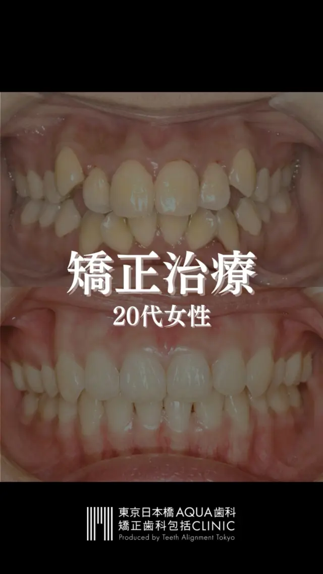 .
【矯正治療】
20代女性の矯正治療経過です。
.
噛み合わせを気にされていた患者様。
矯正治療で、正常な位置に戻す治療を行いました。

#矯正 #矯正治療 #歯並び #歯並び矯正 #出っ歯 #口ゴボ #歯列矯正 #歯並び #歯列矯正 #歯科矯正 #矯正 #矯正歯科 #歯並び矯正 #ワイヤー矯正 #dentist #orthodontics #orthodonticstreatment #orthodonticspecialist #japaneseorthodontics