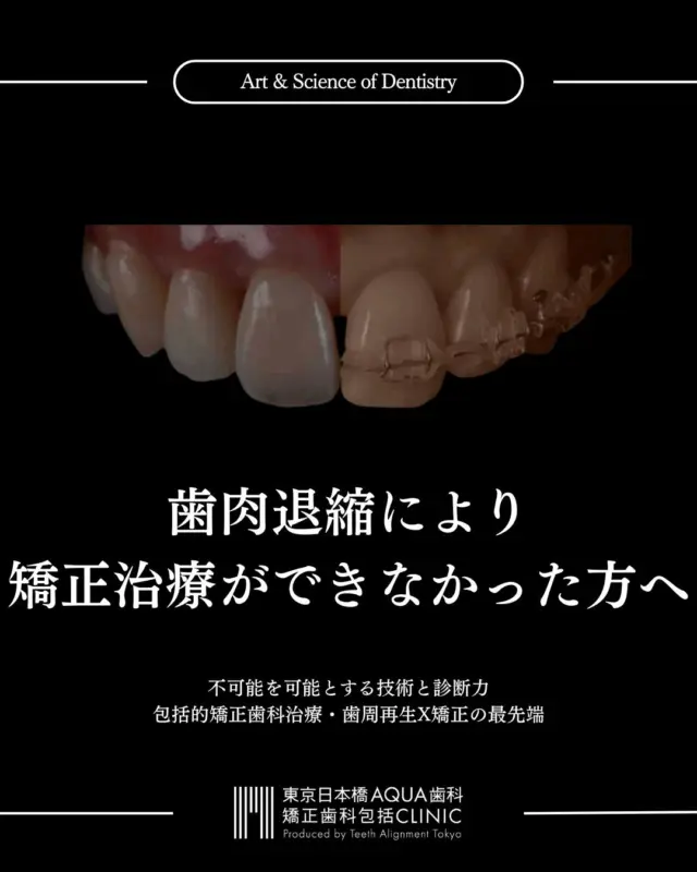 .
【歯肉退縮により矯正治療が難しいと言われた方へ】
.
当院では重度の歯肉退縮に対する治療に長年の経験を持ち、豊富な治療実績を誇ります。
.
歯肉退縮にお悩みの方はぜひ一度カウンセリングにお越しくださいませ。
AI搭載DIP Ceph,セットアップモデルなどを駆使した高精度の治療計画立案後にO-PRO法を実施します。
.
#歯肉退縮 #矯正 #矯正治療 #歯並び #歯並び矯正 #出っ歯 #口ゴボ #歯列矯正 #歯並び #歯列矯正 #歯科矯正 #矯正 #矯正歯科 #歯並び矯正 #ワイヤー矯正 #dentist #orthodontics