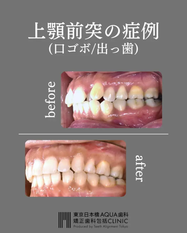 .
【出っ歯・口ゴボにお悩みの方】
.
上顎前突とは上顎が下顎よりも出ている状態、いわゆる出っ歯・口ゴボの状態をさします。
原因はさまざまですが、将来的な虫歯・歯周病、外傷により前歯を失うリスクがあります。
.
状態によっては、抜歯を併用しなければならない可能性もありますが、
口腔状態によっても治療方針は上顎のみ抜歯、上下抜歯、下顎成長促進、外科手術併用など様々なパターンが考えられます。
.
当院では、スクリーニングによる虫歯、歯周病等の検診、精密矯正検査を行いオーダーメイドの治療計画を立案します。
ぜひ一度カウンセリングにお越しくださいませ。
.
#歯周病 #歯肉退縮 #矯正 #矯正治療 #歯並び #歯並び矯正 #出っ歯 #口ゴボ #歯列矯正 #歯並び #歯列矯正 #歯科矯正 #矯正 #矯正歯科 #歯並び矯正 #ワイヤー矯正 #dentist #orthodontics #上顎前突