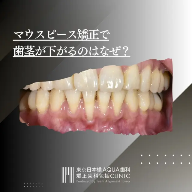 .
【マウスピース矯正で歯茎が下がる？】
マウスピース矯正はさまざまなメリットがある一方で、治療中に「歯茎が下がった」と感じる方が増えています。
.
当院では、矯正治療後の歯肉退縮にお悩みの患者さまのご相談を受け付けております。
お気軽にご相談くださいませ。 
.
#矯正 #矯正治療 #歯並び #歯並び矯正 #出っ歯 #口ゴボ #歯列矯正 #歯並び #歯列矯正 #歯科矯正 #矯正 #矯正歯科 #歯並び矯正 #ワイヤー矯正 #dentist #orthodontics #根幹治療