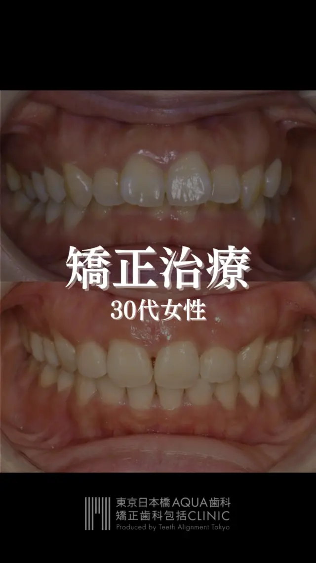 【矯正治療】
30代女性の矯正治療経過です。
.
噛み合わせの深さにお悩みの患者様。歯を正しい位置に戻す治療を行いました。

#矯正 #矯正治療 #歯並び #歯並び矯正 #出っ歯 #口ゴボ #歯列矯正 #歯並び #歯列矯正 #歯科矯正 #矯正 #矯正歯科 #歯並び矯正 #ワイヤー矯正 #dentist #orthodontics