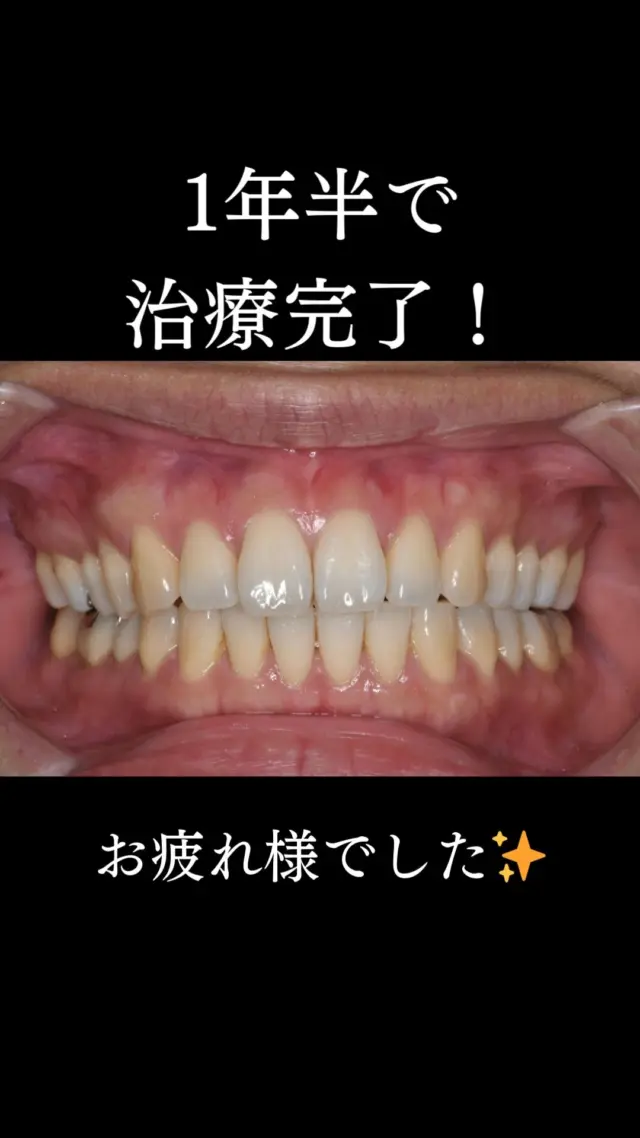 .
【アライナー矯正】
SironaのSure Smileアライナーを使用した矯正治療の症例です。
.
#ホワイトニング #デュアルホワイトニング #矯正 #矯正治療 #歯並び #歯並び矯正 #出っ歯 #口ゴボ #歯列矯正 #歯並び #歯列矯正 #歯科矯正 #矯正 #矯正歯科 #歯並び矯正 #ワイヤー矯正 #dentist #orthodontics #マウスピース矯正 #アライナー矯正