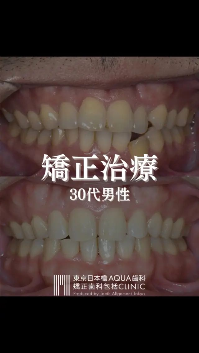 .
【矯正治療】
30代男性の矯正治療症例です。
.
歯並びにお悩みの患者様。歯を正しい位置に戻す治療を行いました。

.
#矯正 #矯正治療 #歯並び #歯並び矯正 #出っ歯 #口ゴボ #歯列矯正 #歯並び #歯列矯正 #歯科矯正 #矯正 #矯正歯科 #歯並び矯正 #ワイヤー矯正 #dentist #orthodontics