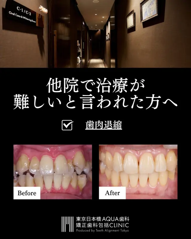 .
【他院では治療が難しいと言われた方へ】歯肉退縮
.
当院では重度の歯肉退縮に対する治療に長年の経験を持ち、豊富な治療実績を誇ります。
.
歯肉退縮にお悩みの方はぜひ一度カウンセリングにお越しくださいませ。
AI搭載DIP Ceph,セットアップモデルなどを駆使した高精度の治療計画立案後にO-PRO法を実施します。
.
#歯肉退縮 #矯正 #矯正治療 #歯並び #歯並び矯正 #出っ歯 #口ゴボ #歯列矯正 #歯並び #歯列矯正 #歯科矯正 #矯正 #矯正歯科 #歯並び矯正 #ワイヤー矯正 #dentist #orthodontics
