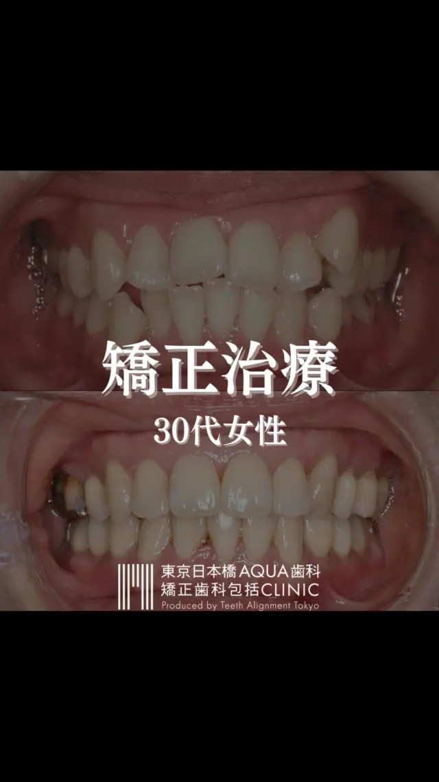 .
【矯正治療】
30代女性の矯正治療の症例です。
.
歯並びを気にされていた患者様。
矯正治療で、正常な位置に戻す治療を行いました。
.
#矯正 #矯正治療 #歯並び #歯並び矯正 #出っ歯 #口ゴボ #歯列矯正 #歯並び #歯列矯正 #歯科矯正 #矯正 #矯正歯科 #歯並び矯正 #ワイヤー矯正 #dentist #orthodontics
