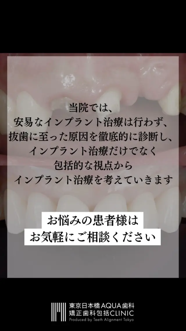 .
【インプラント治療の症例】
当院で行ったインプラント治療の症例のご紹介です。
.
当院では安易なインプラント治療は行わず、抜歯に至った原因を徹底的に診断し、インプラント治療だけでなく包括的な視点からインプラント治療にあたっています。
.
お悩みの患者様、他院で抜歯宣告をされた患者様はお気軽にご相談ください。
.
#インプラント #インプラント治療 #矯正 #矯正治療 #歯並び #歯並び矯正 #出っ歯 #口ゴボ #歯列矯正 #歯並び #歯列矯正 #歯科矯正 #矯正 #矯正歯科 #歯並び矯正 #ワイヤー矯正 #dentist #orthodontics #歯肉退縮 #歯肉 #歯茎が下がる