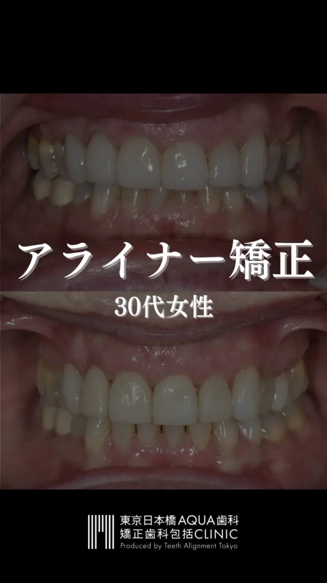 .
【アライナー矯正】
シロナのSure Smileアライナーを使用した矯正治療の症例です。
.
#ホワイトニング #デュアルホワイトニング #矯正 #矯正治療 #歯並び #歯並び矯正 #出っ歯 #口ゴボ #歯列矯正 #歯並び #歯列矯正 #歯科矯正 #矯正 #矯正歯科 #歯並び矯正 #ワイヤー矯正 #dentist #orthodontics #マウスピース矯正 #アライナー矯正