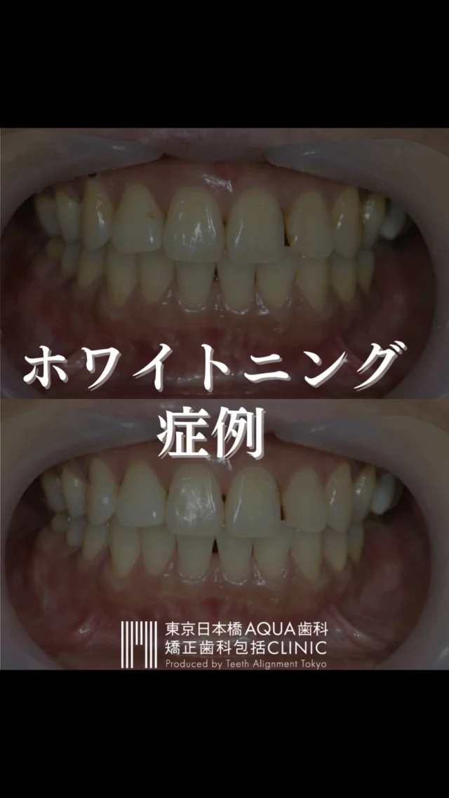 .
【デュアルホワイトニング】
クリニック1回・ホーム2週間で、歯の明るさは3段階上がりました✨
.
#ホワイトニング #デュアルホワイトニング #矯正 #矯正治療 #歯並び #歯並び矯正 #出っ歯 #口ゴボ #歯列矯正 #歯並び #歯列矯正 #歯科矯正 #矯正 #矯正歯科 #歯並び矯正 #ワイヤー矯正 #dentist #orthodontics