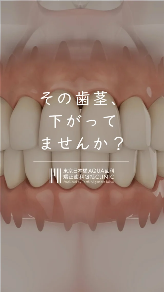 .

「歯が長くなった気がする…」
「歯ぐきが下がってきたかも？」

そんなお悩みは、歯肉退縮が原因かもしれません。

歯肉退縮は見た目の変化だけでなく
知覚過敏や歯周病の進行などにつながることもあります。

今回の動画では
✔︎ 歯肉退縮の原因
✔︎ 治療の選択肢
についてご紹介しました。

当院では、院長が開発したO-PRO法により
歯茎だけでなく骨の再生も促し
歯周組織全体の回復を目指す治療を行っています。

「O-PRO法はどんな治療なの？」と気になった方は
ぜひこのアカウントをフォローして
次回の投稿をお待ちください📱

歯茎の変化が気になる方や
他院で治療が難しいと言われた方は
お気軽にご相談ください。

▼あなたはどのタイプ？
①鏡で見て気づいた
②知覚過敏で気づいた
③言われて初めて知った
コメントで教えてください✍🏻

#日本橋歯科 #包括的矯正歯科 #歯肉退縮 #知覚過敏
#OPRO法