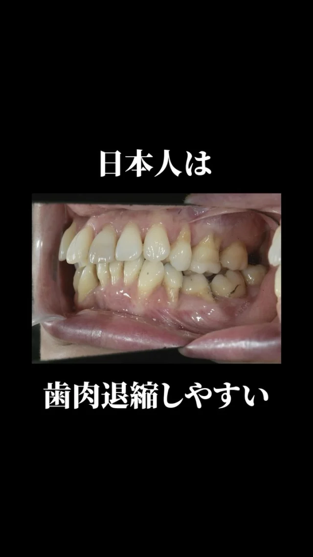 日本人は歯肉退縮しやすい人種だと
知っていましたか？

実は歯肉の厚さは人種によって異なり、
アジア人・日本人は欧米人と比べて
歯茎が薄い傾向があることが
データで示されています。

さらに近年、成人矯正が増えるにつれて
大人の方が矯正をすると
歯肉退縮のリスクが高まることも
わかってきています。

つまり日本人にとって
矯正治療と歯肉退縮は
切っても切れない関係があるのです。

「矯正したいけど歯茎が心配」
「歯茎が薄いと言われたことがある」
そのようなお悩みをお持ちの方は
ぜひ最後まで動画をご覧ください。

次回は「歯肉退縮は治せないのか？」
院長が正直に答えます。
フォローして次回の投稿をお待ちください✍🏻

#日本橋歯科 #歯肉退縮 #OPRO法 #矯正歯科 #包括的矯正歯科