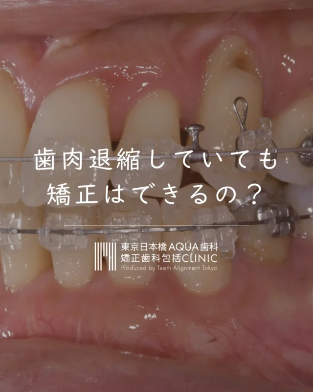 .

矯正したいけど
歯茎のことが心配な方へ。

矯正と歯周——
この2つをつなぐ
新しい治療概念があります。

気になる方はプロフィールのリンクから
お気軽にご相談ください✉️

次回はO-PRO法の詳しい治療内容と
どんな方に向いているかを解説します。
フォローして次回の投稿をお待ちください✍🏻

#日本橋歯科 #歯肉退縮 #OPRO法 #矯正歯科 #歯周病治療