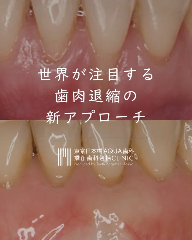 .

歯茎だけでなく
骨の再生も促すアプローチ——

O-PRO法が従来治療と
根本的に異なる理由を
解説しています。

「自分に適応があるか知りたい」
という方はまずご相談ください👆

フォローして次回の投稿をお待ちください✍🏻

#日本橋歯科 #歯肉退縮 #OPRO法 #包括的矯正治療 #矯正歯科