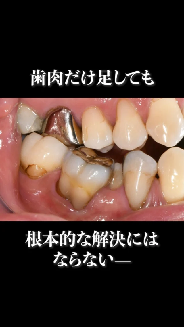.

歯肉だけ足しても
根本的な解決にはならない——

では、どうすればいいのか。

院長が開発に至るまでの
研究と想いをお話しします。

気になる症状がある方はプロフィールのリンクから
お気軽にご相談ください✉️

#日本橋歯科 #歯肉退縮 #OPRO法 #歯周病治療 #矯正歯科