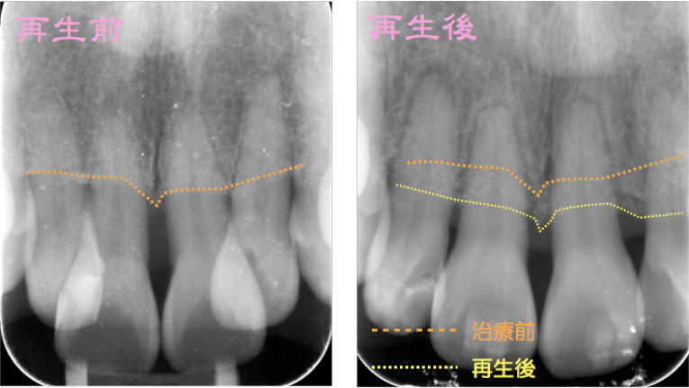 外科的歯周再生療法3