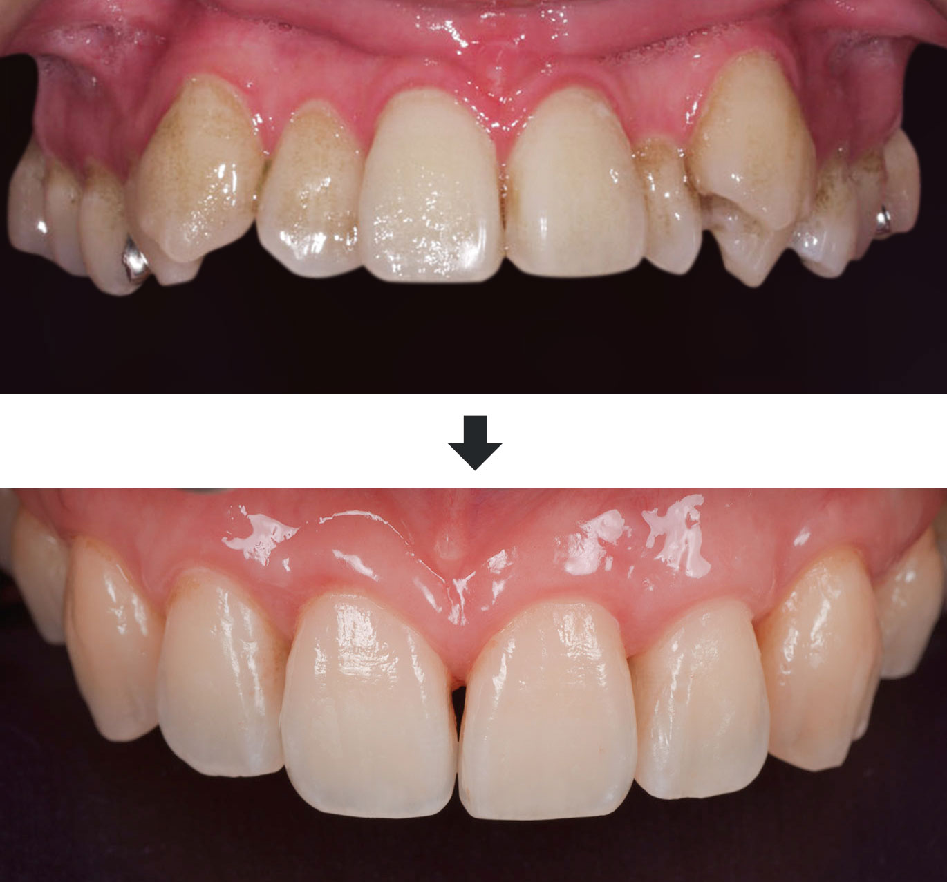 非外科的歯周再生治療症例