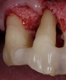 外科的歯周再生療法1